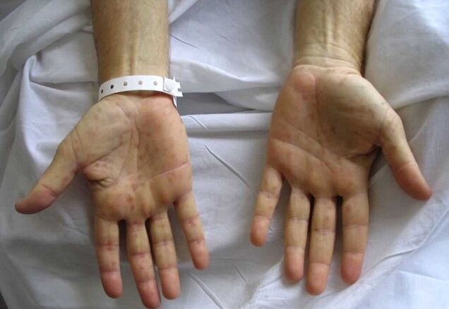 syphilis on the hand as the cause of abnormal discharge from the penis